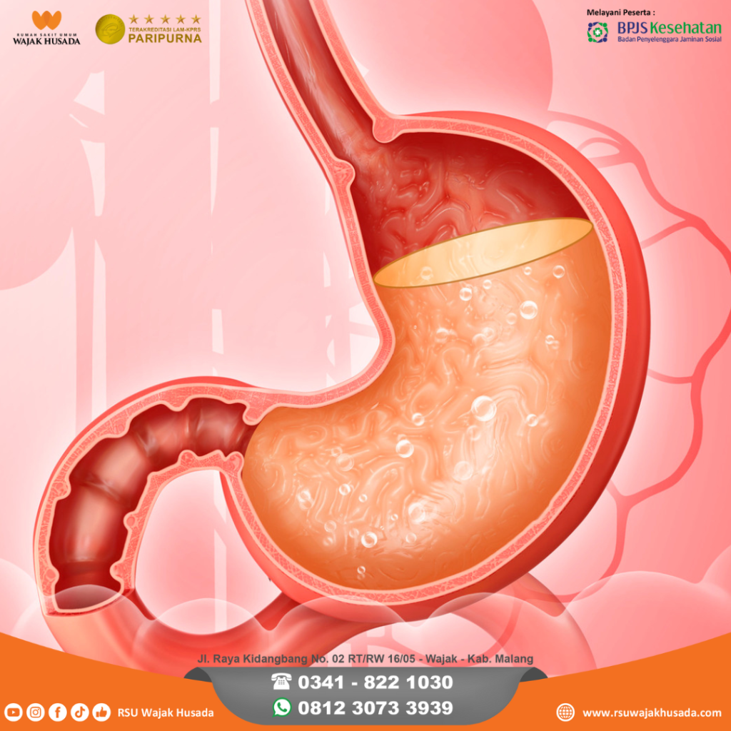 Kesalahan Umum Saat Menghadapi Asam Lambung Hindari Kekeliruan Ini Untuk Pencernaan Yang Lebih Baik